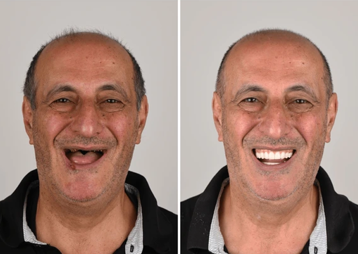 Allday Secure Gebislime