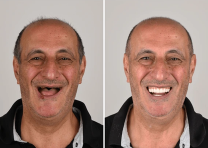 Allday Secure Gebislime