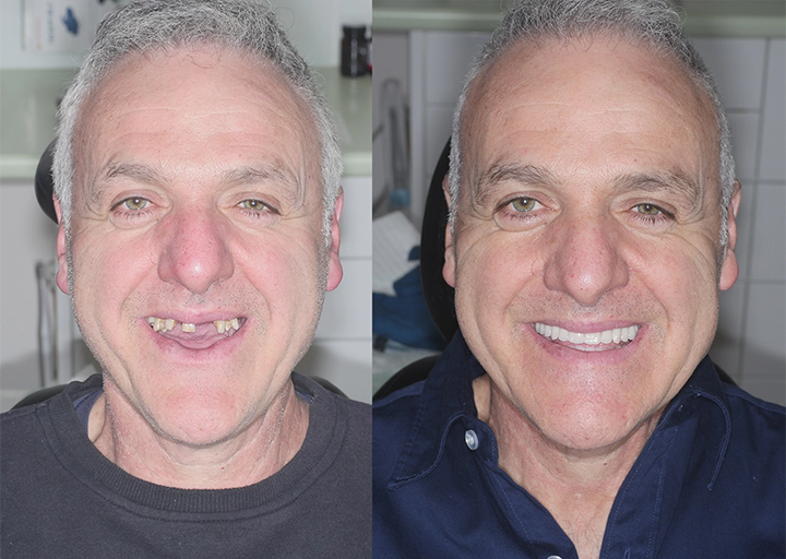 Allday Secure Gebislime